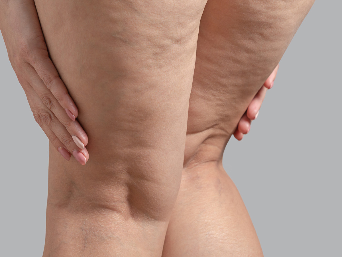 Lipedema e qualità della vita: dati e statistiche